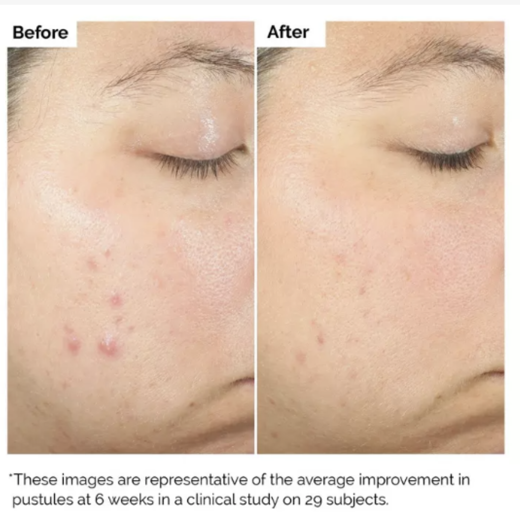 The Ordinary Acido Salicílico 2% IDEAL PARA PIEL GRASA Y CON ACNÉ - Tu Shopper Beauty