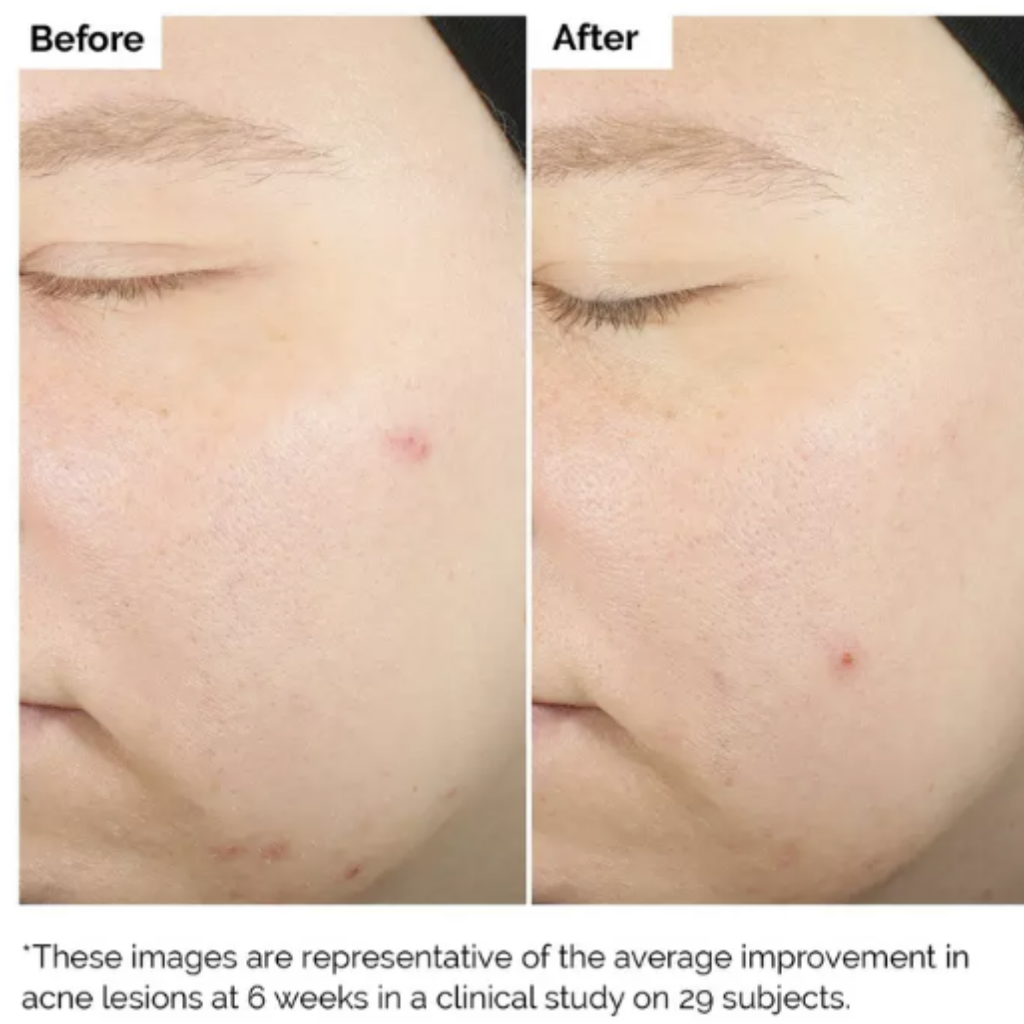 The Ordinary Acido Salicílico 2% IDEAL PARA PIEL GRASA Y CON ACNÉ - Tu Shopper Beauty